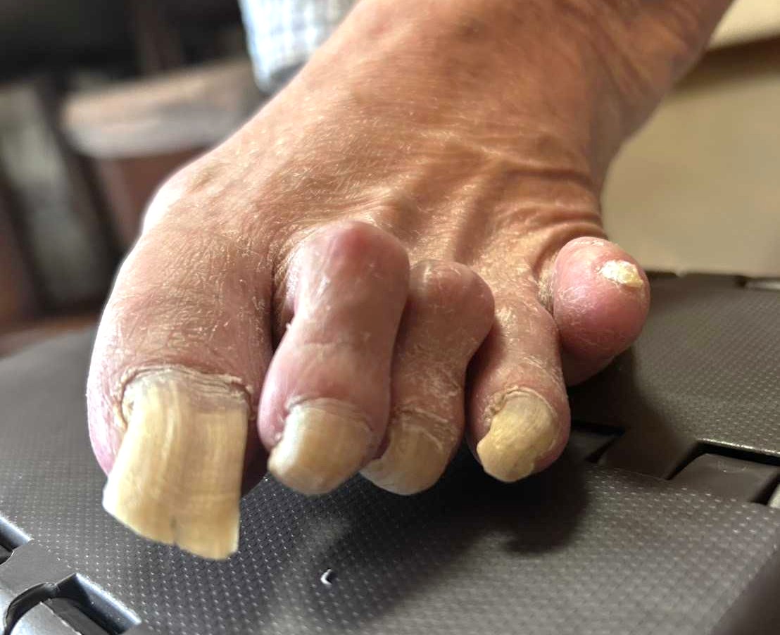 肥厚爪（分厚くなった爪）の症状例