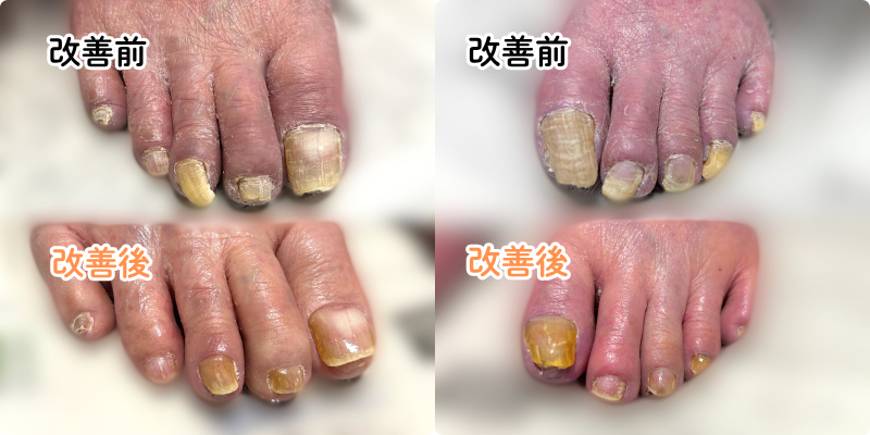 ベラミのネイルケア 広島市での巻き爪・肥厚爪の出張施術の様子